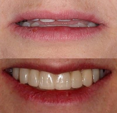 Vaneers Cosmetic Dentistry Whitten Omaha 001