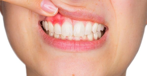 Gum Treatments